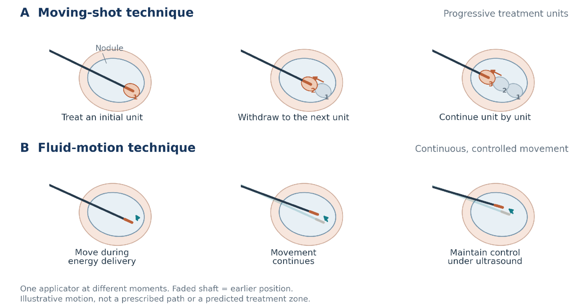 Six schematic snapshots of one applicator within a nodule. Moving-shot progresses through small treatment units; fluid-motion shows ongoing controlled movement, with faded shafts indicating earlier positions.